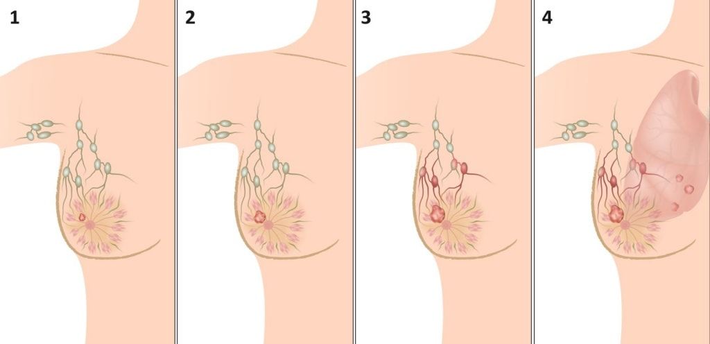стадии рака молочной железы