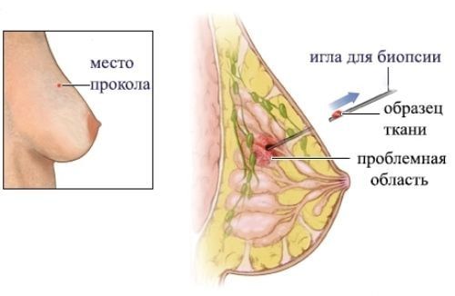трепан-биопсия молочной железы в спб