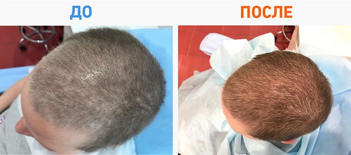 Активация роста волос после химиотерапии